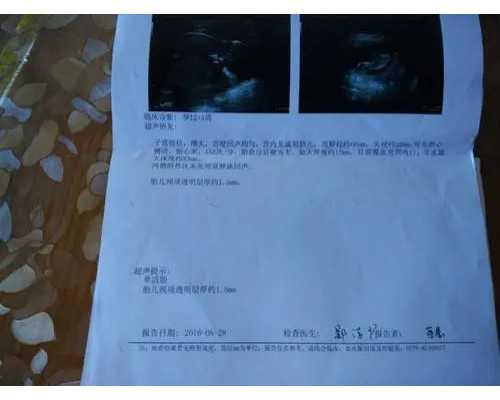 重庆36岁卵巢功能不好做试管,广州白云南方助孕中心